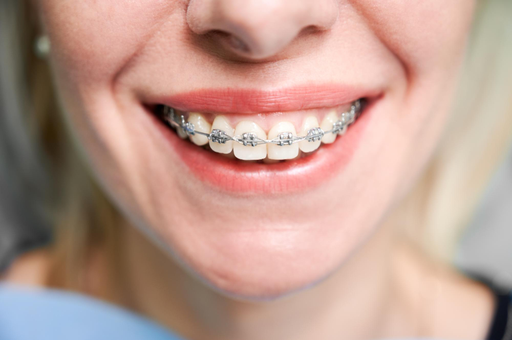 orthodontic services  Tuscaloosa, AL ,  Northport, AL